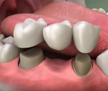 Understanding the Basics About Dental Crowns and Dental Bridges